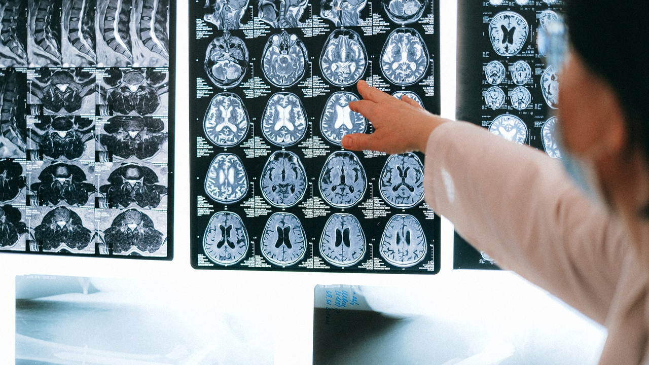 Revisión Neurológica - Control de Alzheimer